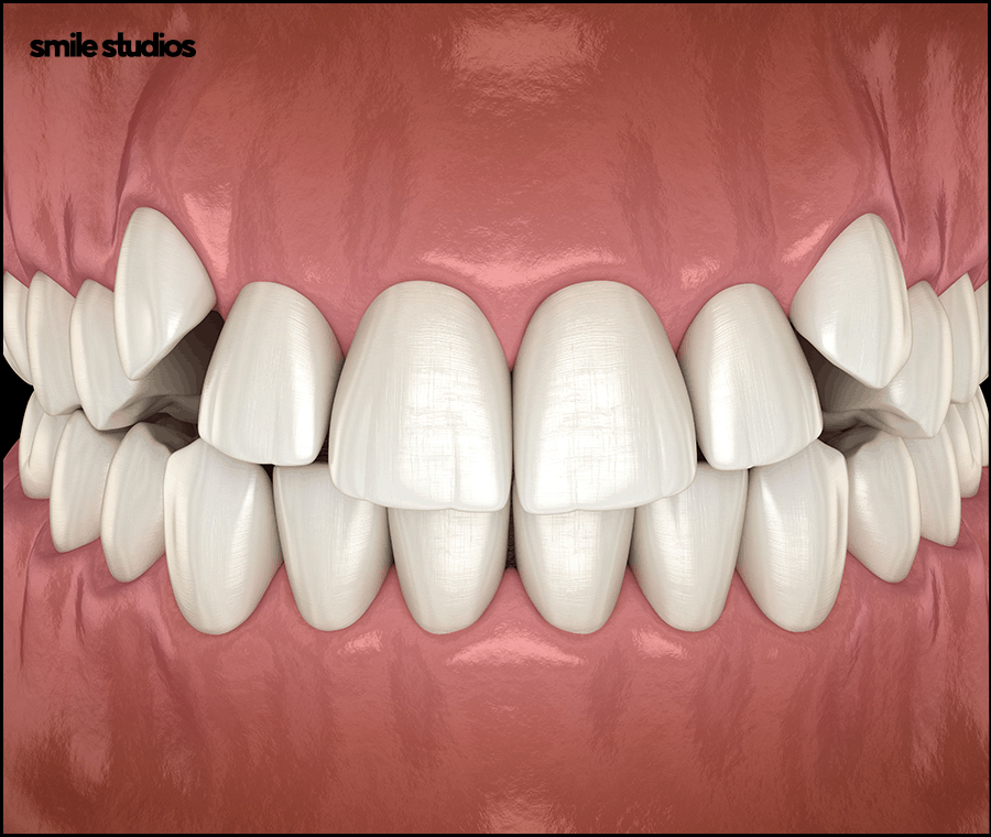 강남논현동치과 인비절라인 과정 및 개선 효과는? 관련 이미지 6