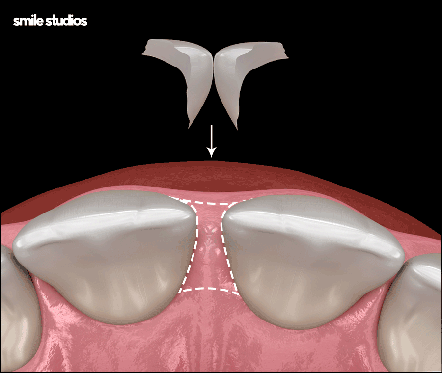 앞니 벌어짐 교정? 라미네이트? 케이스별 추천 방법 관련 이미지 7