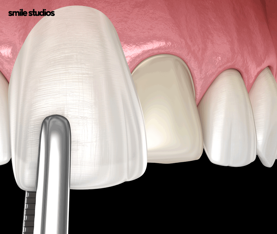 이빨사이벌어짐 부분 교정, 라미네이트 선택 Tip 관련 이미지 6