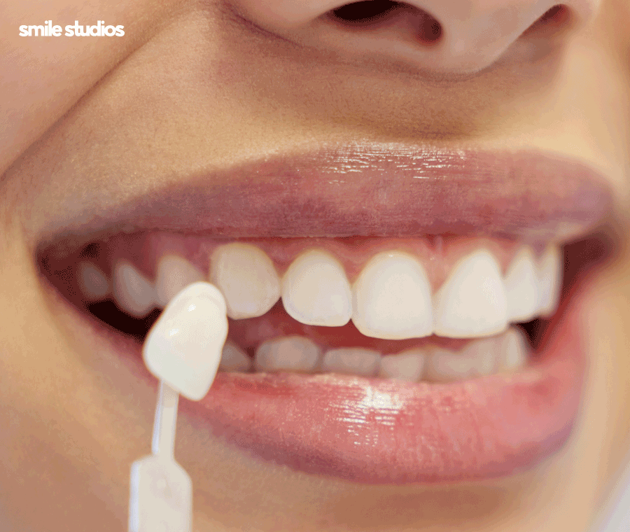 무삭제 라미네이트 효과, 원리, 선호하는 이유 A to Z 관련 이미지 2