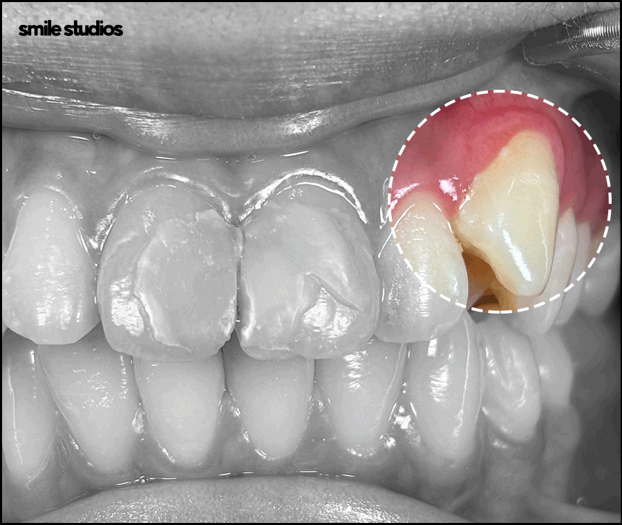 덧니라미네이트 해결 가능할까요? ft. 가능한 케이스 관련 이미지 4