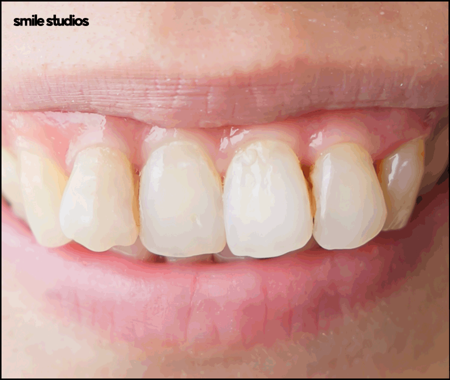 인비절라인 통증이 적은 결정적인 이유 알아보기 관련 이미지 2