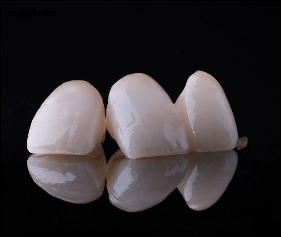 최소삭제 라미네이트 성공하려면 체크할 점 관련 이미지 8