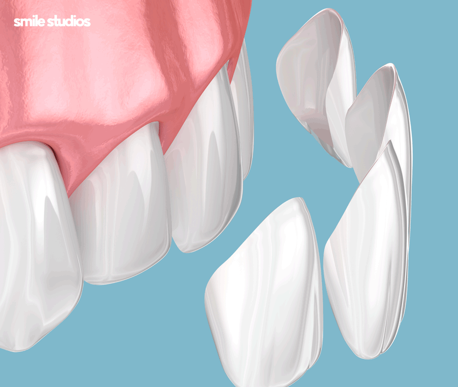 압구정로데오치과 라미네이트 하기 전 체크할 사항 관련 이미지 5