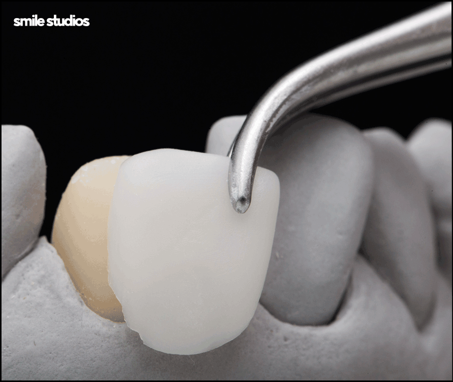 앞니 크랙 금간 치아, 빠른 수복 방법 알아보기 관련 이미지 8