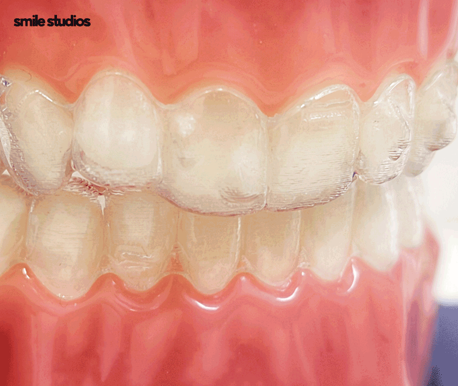 잠원동치과 투명교정 나노라이너, 인비절라인 비교 관련 이미지 7