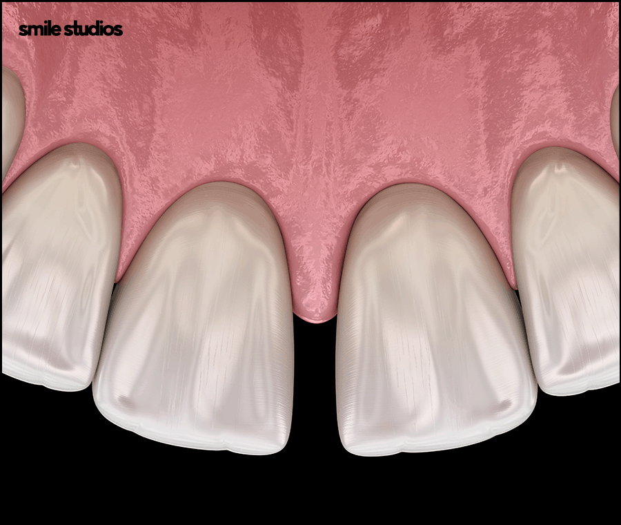 Why Are Veneers Preferred for Gaps Between the Front Teeth? image 2