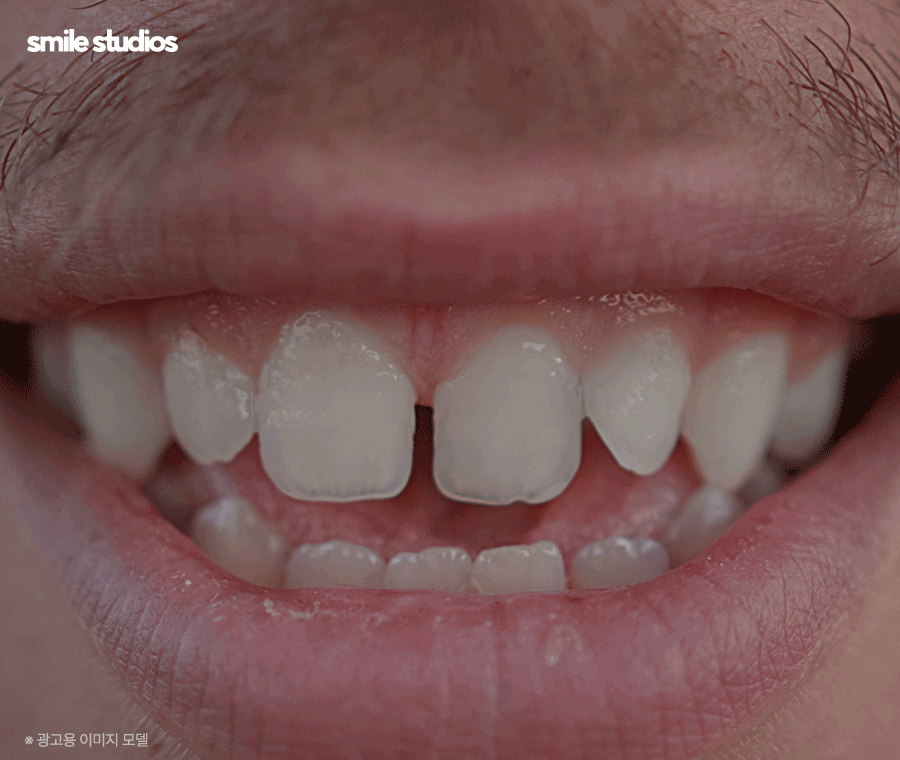 이빨교정비용 좌우하는 기준점 알아보기 관련 이미지 2