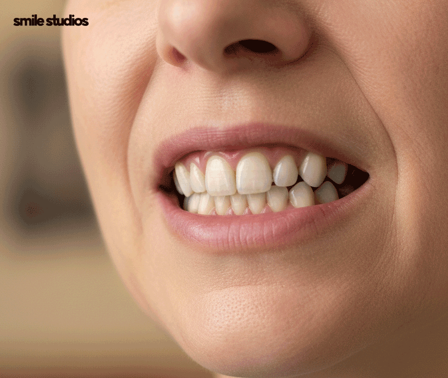 50대 치아교정 늦지 않은 이유, 방법, 효과 정리 관련 이미지 7