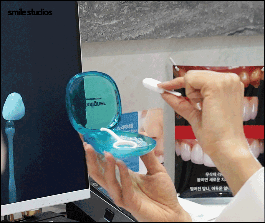 50대 치아교정 늦지 않은 이유, 방법, 효과 정리 관련 이미지 6