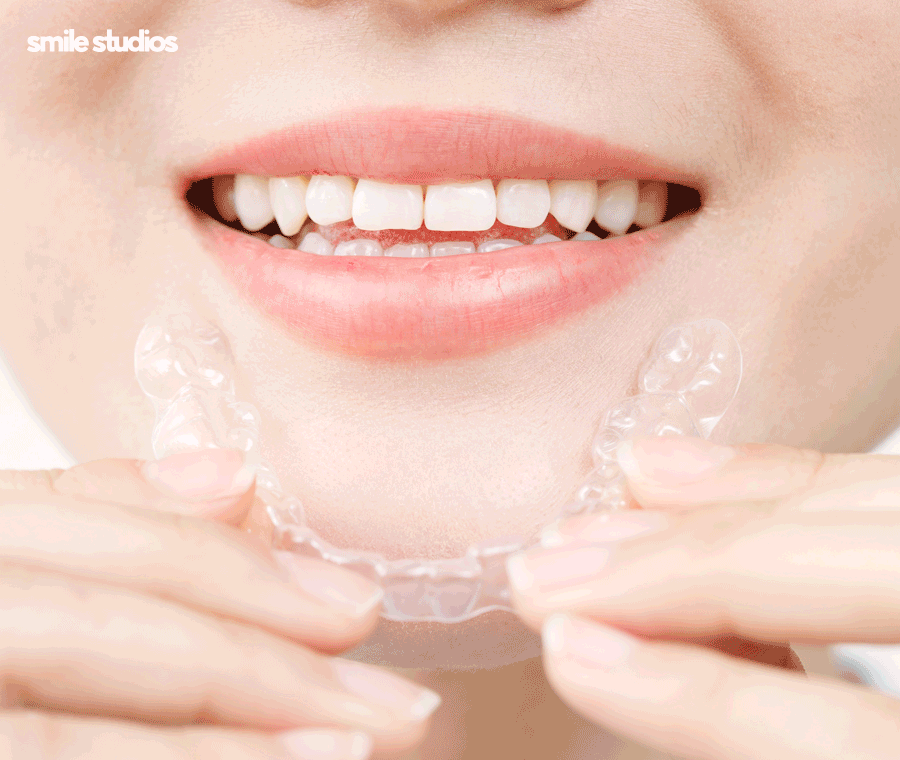 인비절라인 통증이 적은 결정적인 이유 알아보기 관련 이미지 8