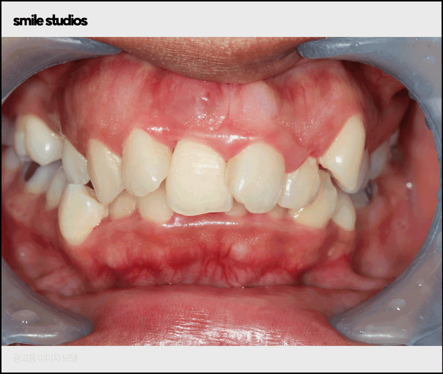 강남치과의원, 나노라이너 특징 및 효과 알아보기 관련 이미지 5