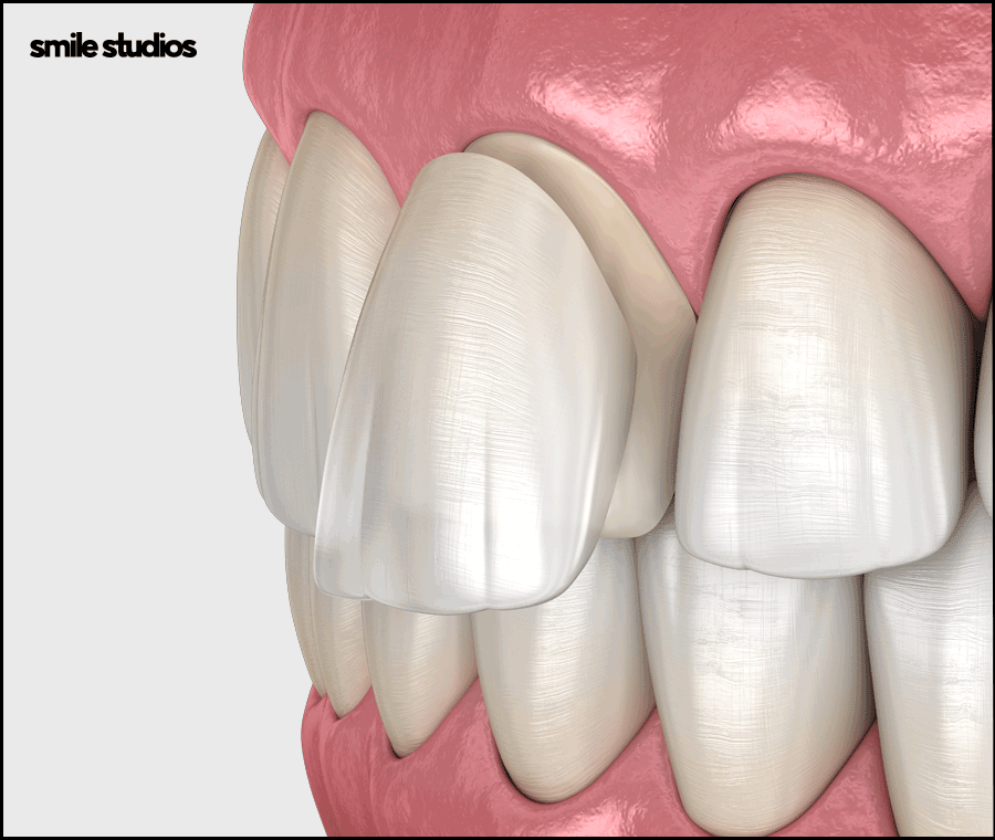 라미네이트제거 시기 및 유지력, 알아둘 사항 관련 이미지 9