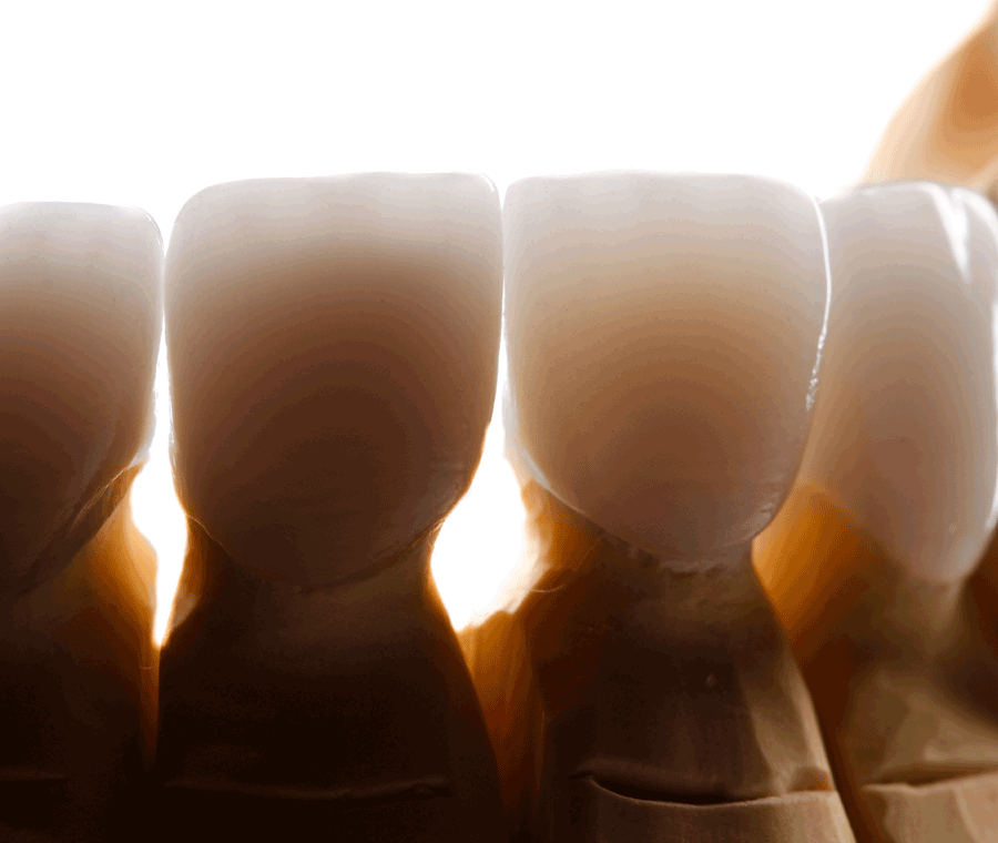 거미스마일 앞니 잇몸 과노출, 원인 및 보완 방법 관련 이미지 9