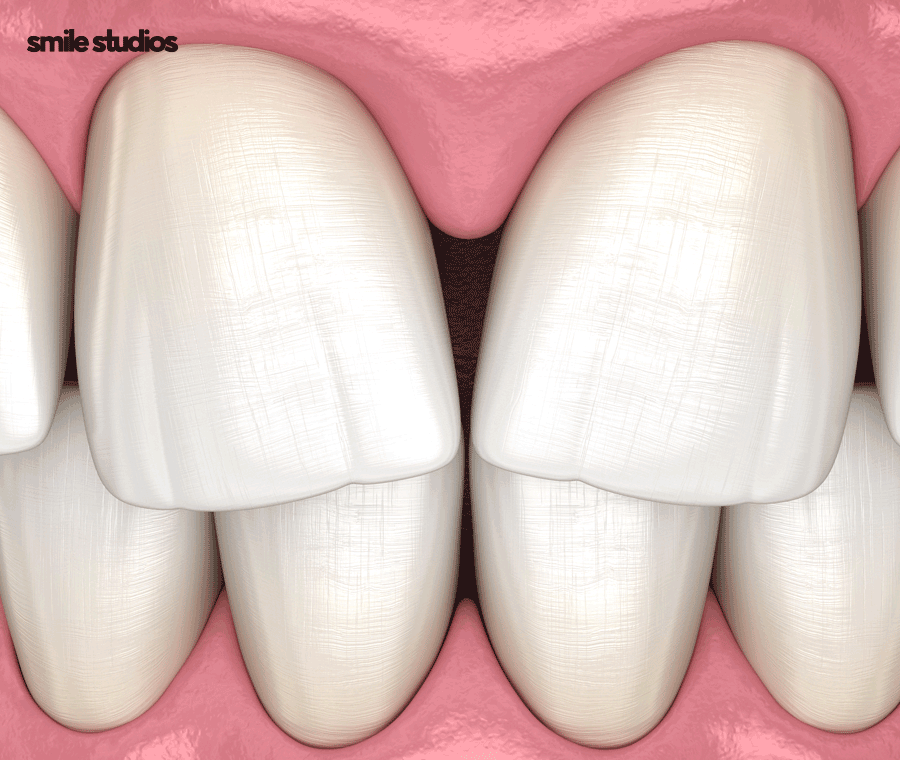 강남 신사역 치과 앞니 벌어짐 교정vs라미네이트 관련 이미지 2