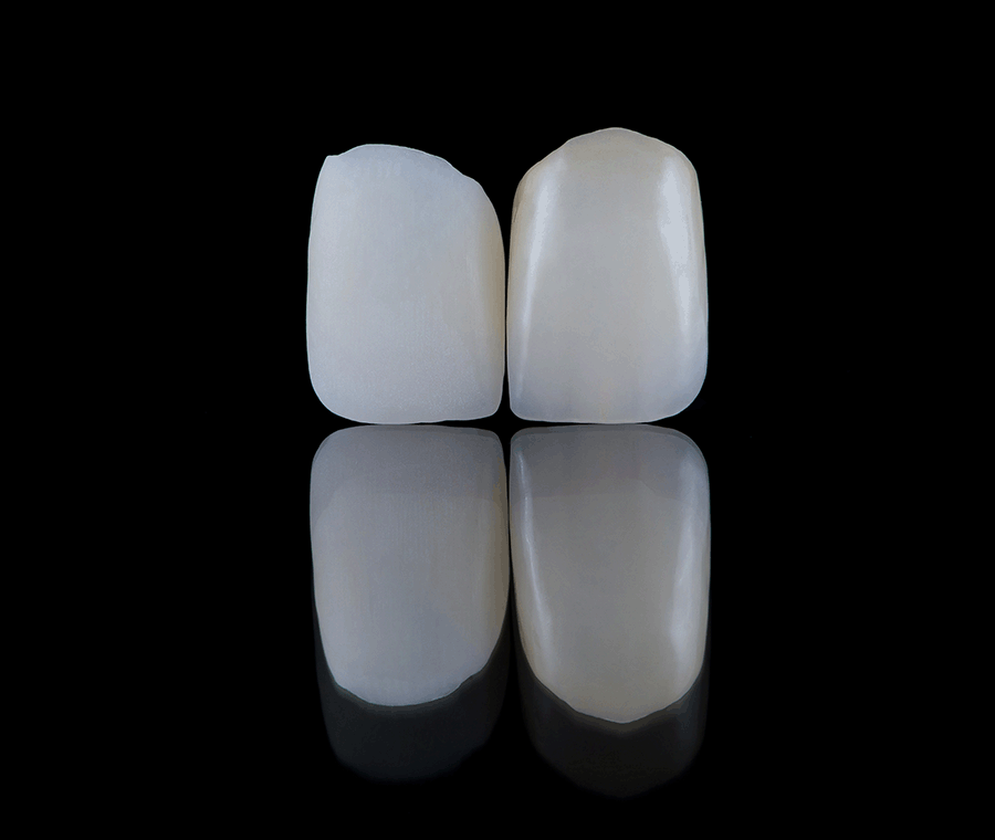 앞니무삭제라미네이트 핵심이 되는 사항은? 관련 이미지 3