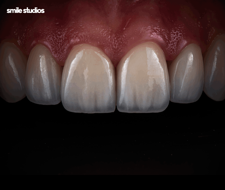 논현 라미네이트 시술 고민된다면 필수체크 관련 이미지 6