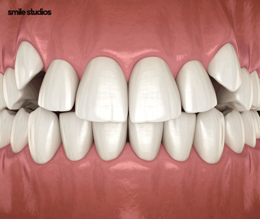 덧니교정 비용보다 중요하게 생각해야 하는 핵심 관련 이미지 2