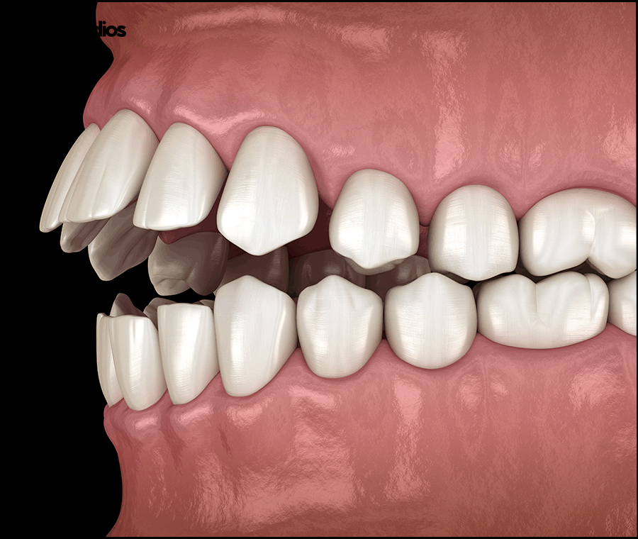 강남 인비절라인 찾는 이유, 치료 가능 범위는? 관련 이미지 7