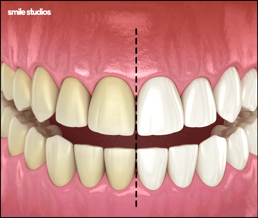 연예인라미네이트 선호도가 높은 이유, 효과 관련 이미지 5