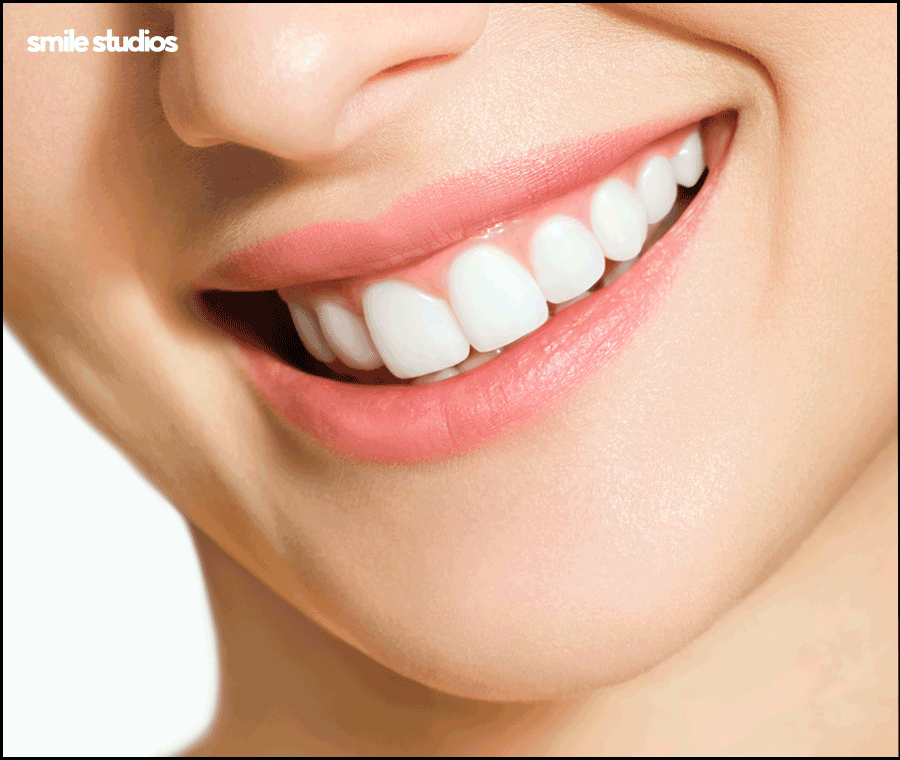 치아무삭제라미네이트 사실과 오해 알아보기 관련 이미지 9