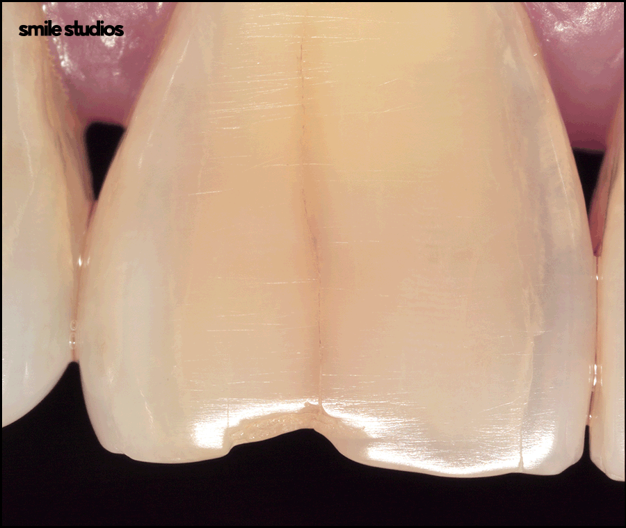 앞니 크랙 금간 치아, 빠른 수복 방법 알아보기 관련 이미지 5