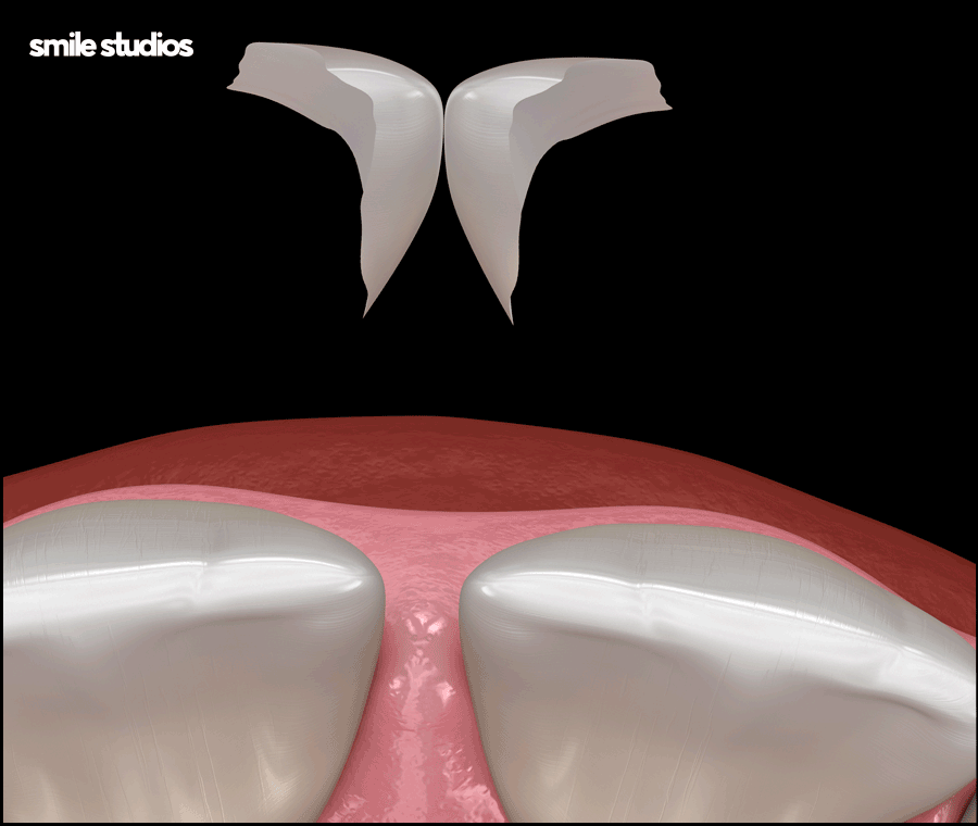 이빨사이벌어짐 부분 교정, 라미네이트 선택 Tip 관련 이미지 8