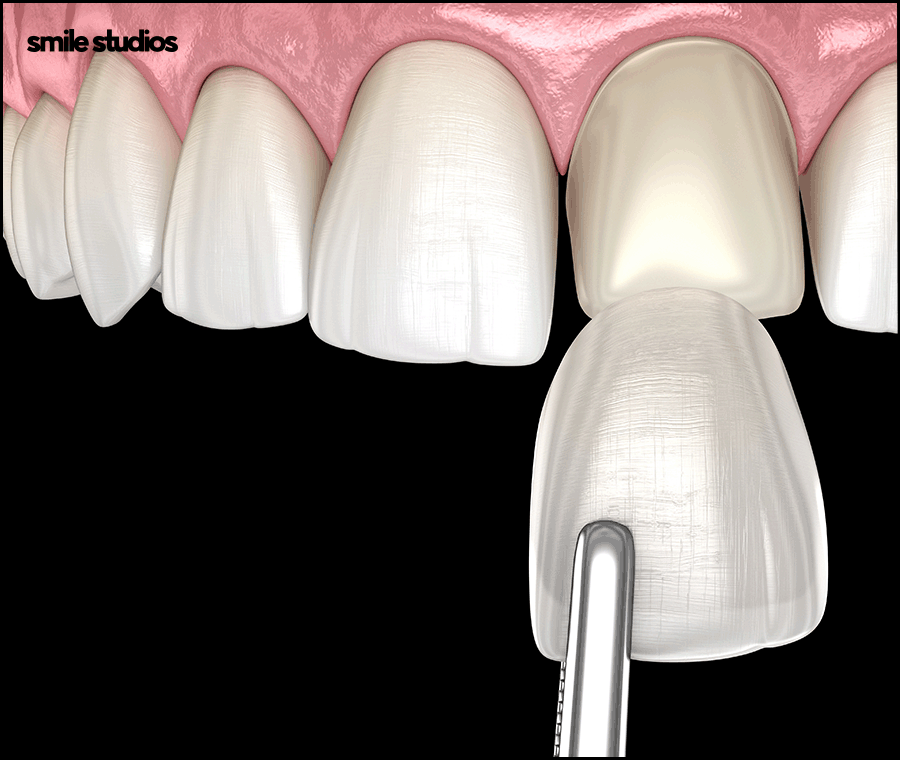 누런이빨 라미네이트 보완 효과, 미백과 차이점 관련 이미지 8