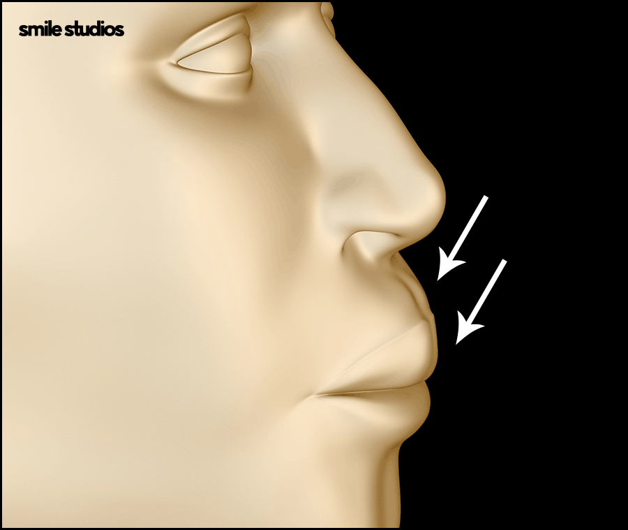 반포동 치과 돌출입 교정, 인비절라인 효과는? 관련 이미지 6
