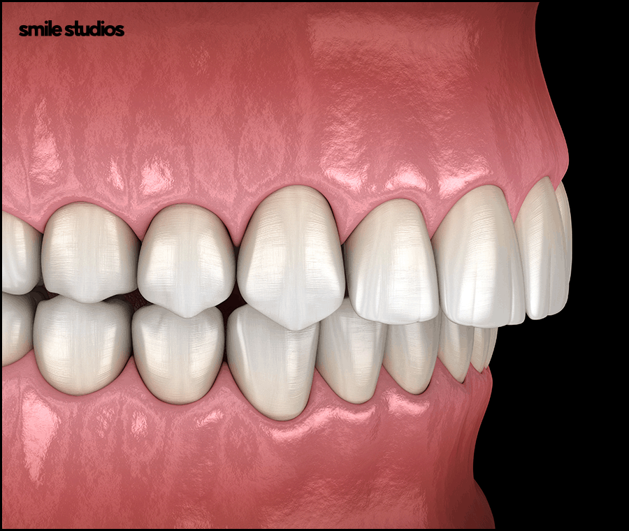 반포동 치과 돌출입 교정, 인비절라인 효과는? 관련 이미지 8