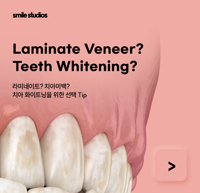 누런이빨 라미네이트 보완 효과, 미백과 차이점 관련 이미지 1