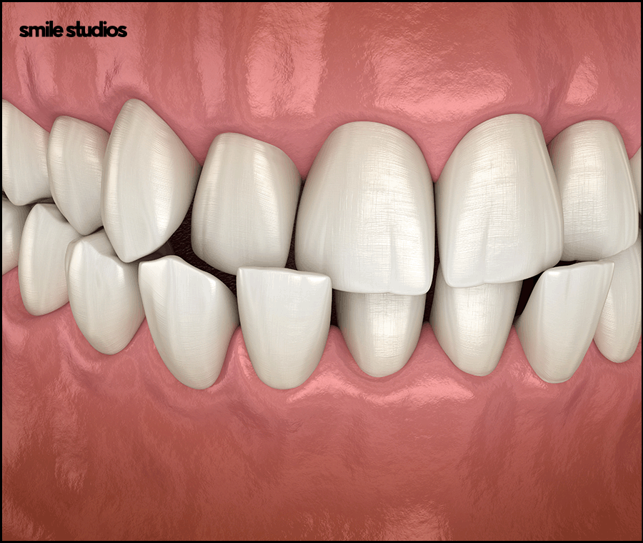 강남 인비절라인 찾는 이유, 치료 가능 범위는? 관련 이미지 8