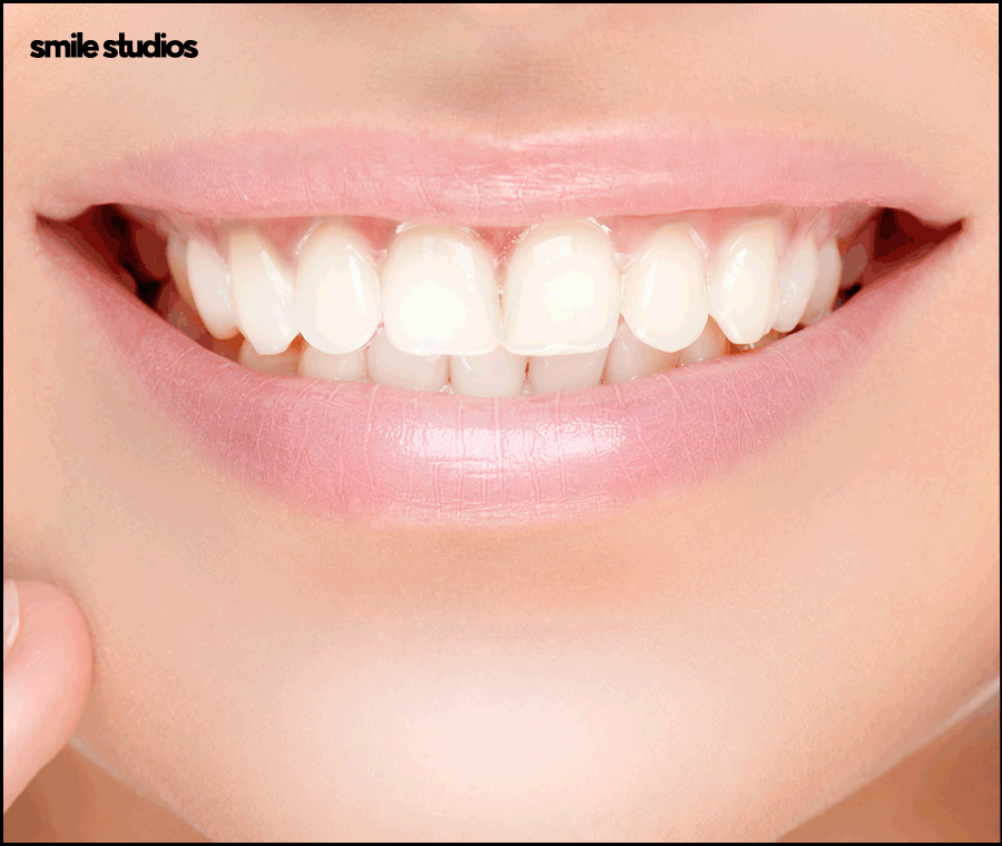 거미스마일 미소의 결함, 해결 방법 ft. 라미네이트 관련 이미지 10