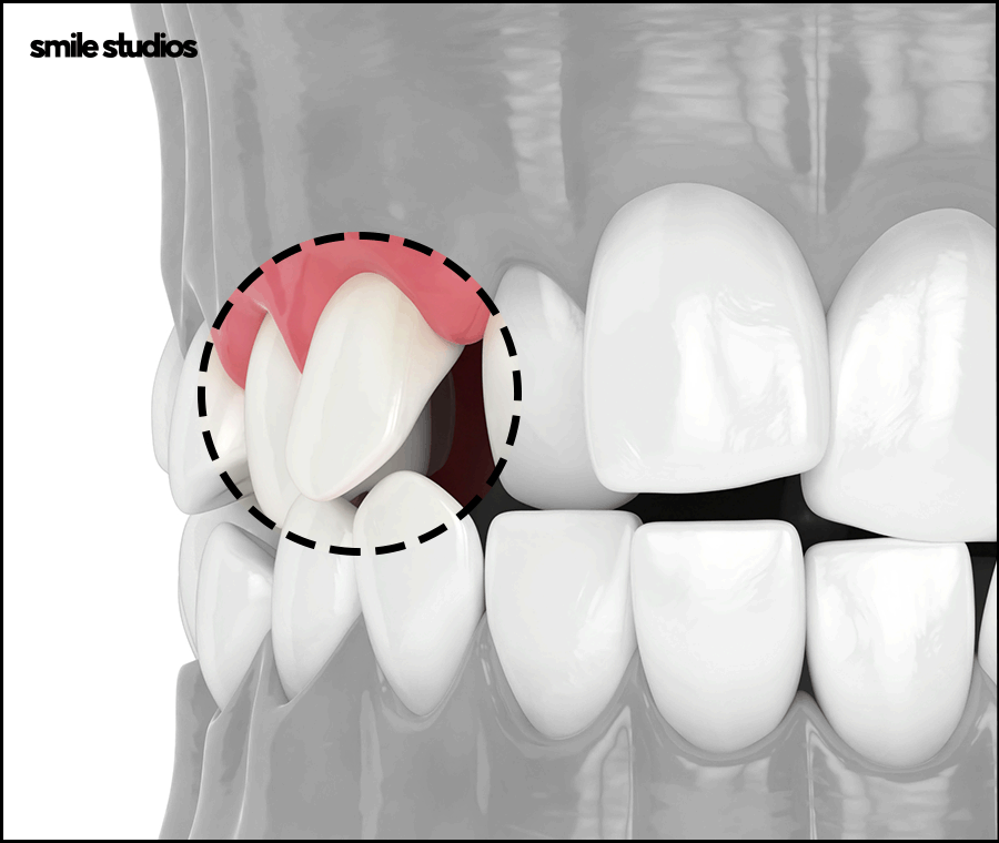 덧니라미네이트 해결 가능할까요? ft. 가능한 케이스 관련 이미지 5