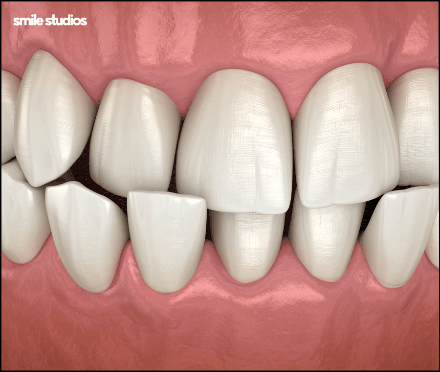 라미네이트 교정 효과를 기대할 수 있는 케이스는? 관련 이미지 5