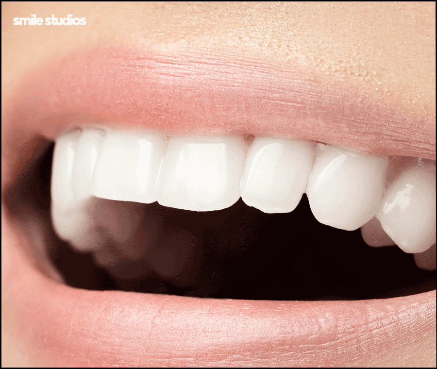 논현동 치과 인비절라인 투명교정 효과, 장/단점 관련 이미지 8