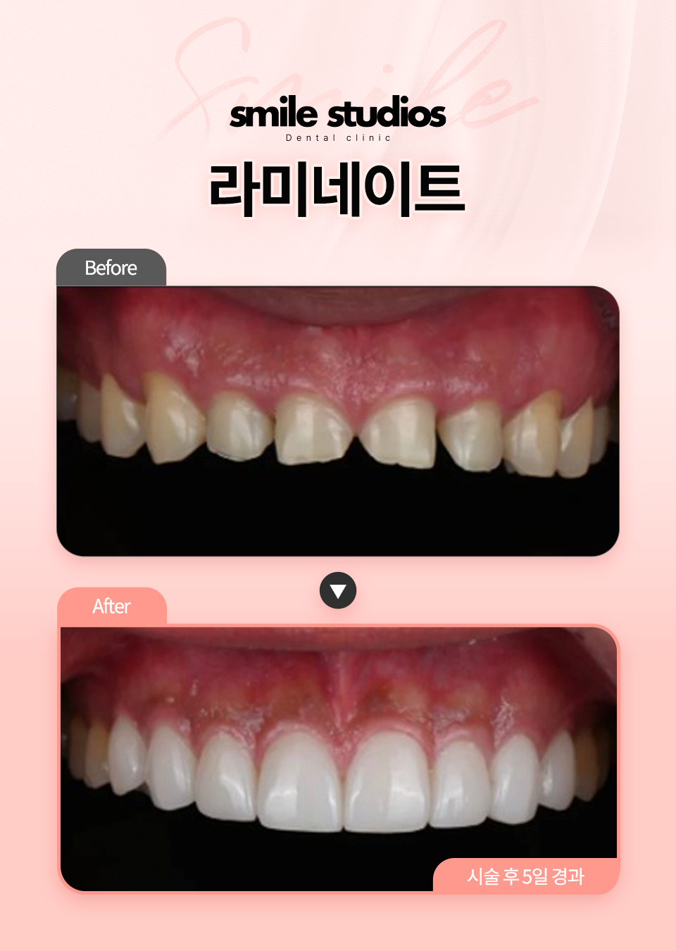 라미네이트 후기, 이것 모르면 100% 후회합니다 관련 이미지 7