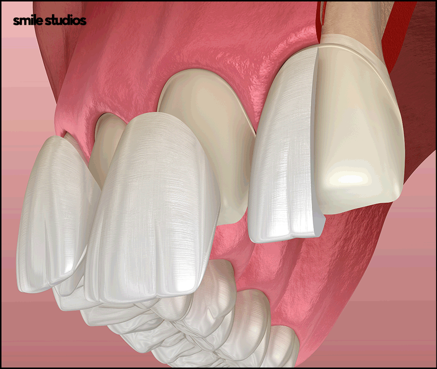 강남역 치과 라미네이트 섬세한 접근의 중요성 관련 이미지 2