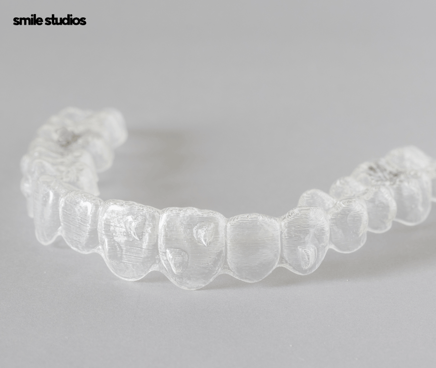 중년치아교정 소요 시간 포함 시작 전 체크할 사항 관련 이미지 3