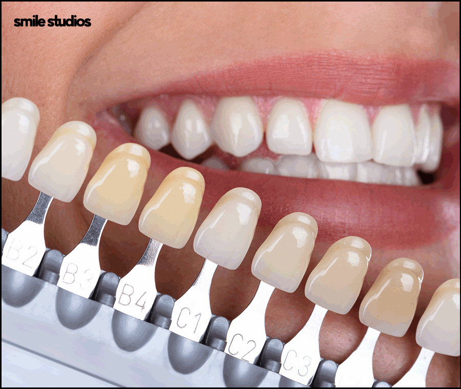 치아반점치 흰얼룩 발생하는 원인, 회복 방법 관련 이미지 8