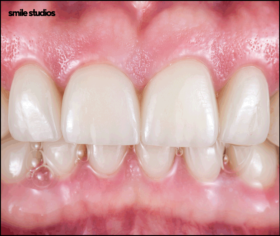 치아무삭제라미네이트 사실과 오해 알아보기 관련 이미지 6