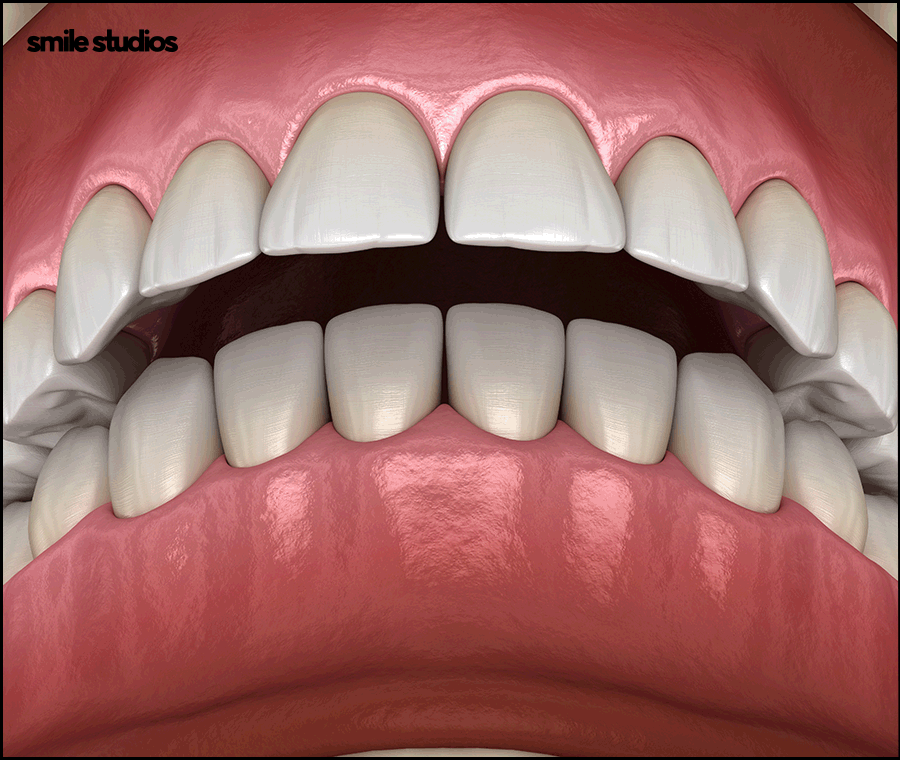 돌출입 인비절라인 기간, 과정, 개선 효과 관련 이미지 2