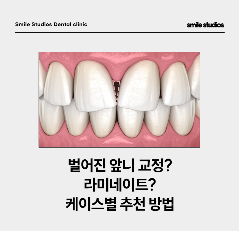 앞니 벌어짐 교정? 라미네이트? 케이스별 추천 방법 관련 이미지 1