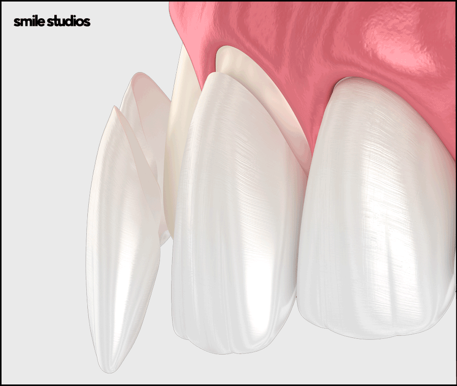 앞니 라미네이트가격 확인 시 같이 체크할 OO은? 관련 이미지 8