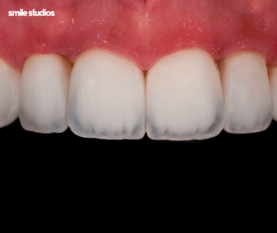 서초 신논현 치과 무삭제 라미네이트 특징, 장단점 관련 이미지 5