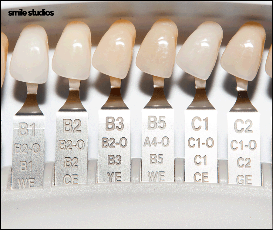 치과라미네이트 고른 치아 만들 때 핵심은? 관련 이미지 9