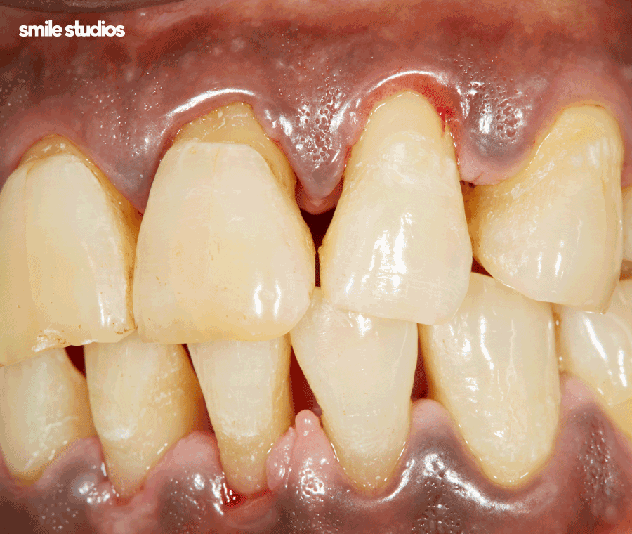 치아 사이 검은색 나타나는 이유, 회복 방법은? 관련 이미지 3