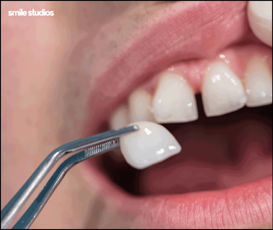 강남역 치과 라미네이트 섬세한 접근의 중요성 관련 이미지 8