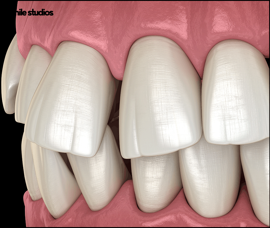 앞니 벌어짐 교정? 라미네이트? 케이스별 추천 방법 관련 이미지 4