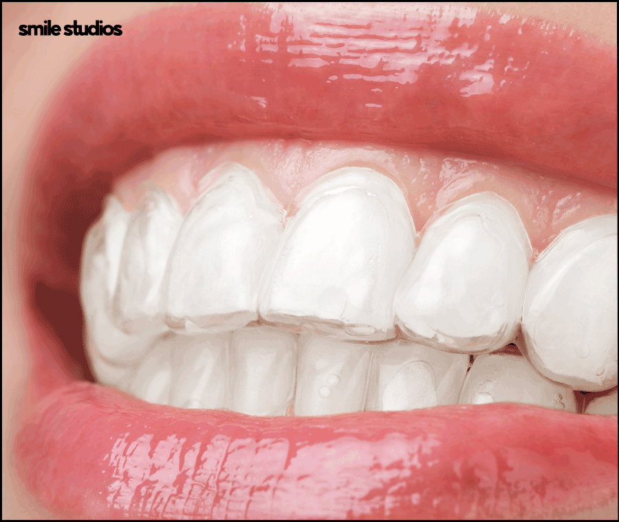 서울인비절라인 권장 케이스, 장점, 치료 시간 정리 관련 이미지 2